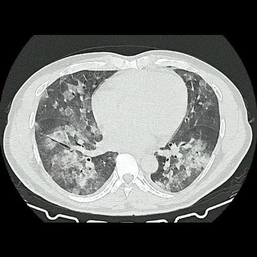 Tomografia de torax sin contraste endovenosos (Ventana pulmonar-corte axial)
