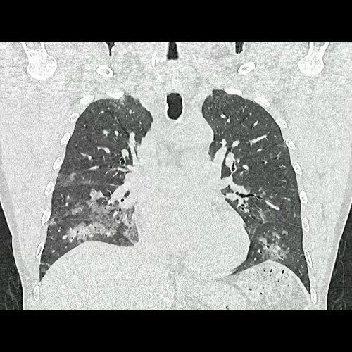 Tomografia de torax sin contraste endovenosos (Ventana pulmonar- Corte coronal)