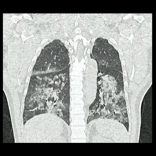 Tomografia de torax sin contraste endovenosos (Ventana pulmonar- Corte coronal)