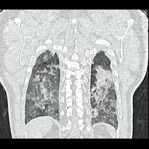 Tomografia de torax sin contraste endovenosos (Ventana pulmonar- Corte coronal)