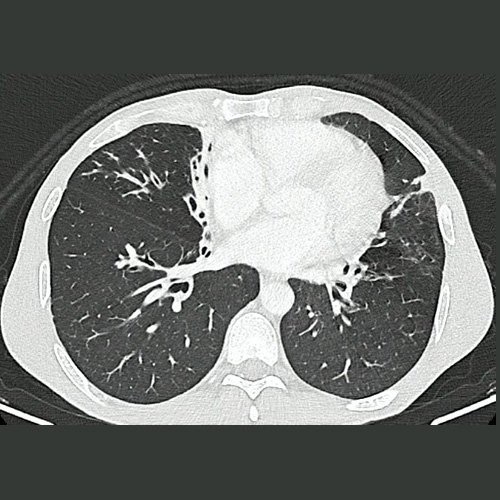 Tomografía de tórax (Ventana pulmonar-corte axial) DÍA 1