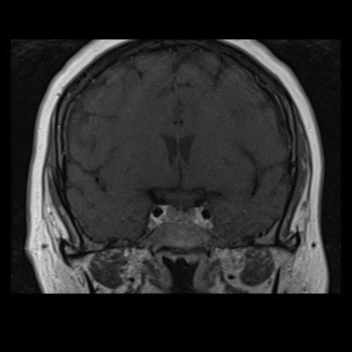 RMN de cráneo con contraste endovenoso (21/02/26) Corte coronal en secuencia T1: sin alteraciones en región selar.