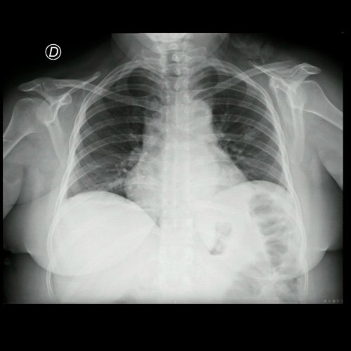 Radiografia de torax (frente) (al ingreso, 26/02/2026)