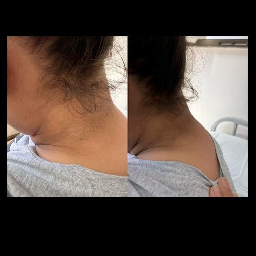 Giba dorsocervical. Acantosis nigricans.