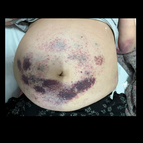 Abdomen globuloso. Hematomas. Estrías cutáneas