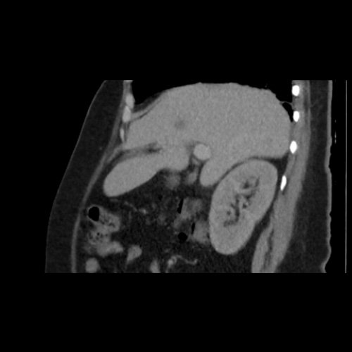 TC de abdomen y pelvis con contraste endovenoso (12/02/2026) Corte sagital: hígado de forma, tamaño y situación habituales, con superficie lisa y bordes agudos.  Imagen hipovascular aislada de 15 mm en segmento V de aspecto inespecífico. 