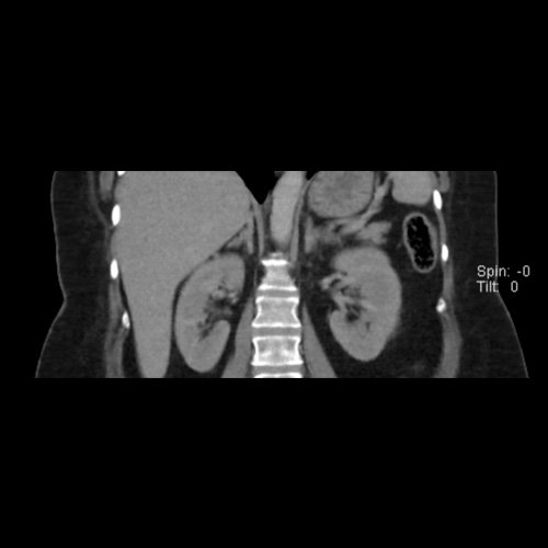 TC de abdomen y pelvis con contraste endovenoso (12/02/2026) Corte coronal: adenoma adrenal izquierdo de 16 mm.