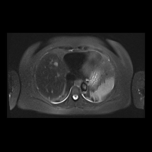 RMN de abdomen con contraste endovenoso (14/02/26)  Corte axial (T2): múltiples lesiones sólidas de distribución difusa, levemente hiperintensas. 