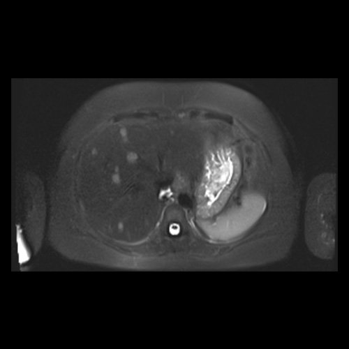 RMN de abdomen con contraste endovenoso (14/02/26)  Corte axial (T2): múltiples lesiones sólidas de distribución difusa, levemente hiperintensas.