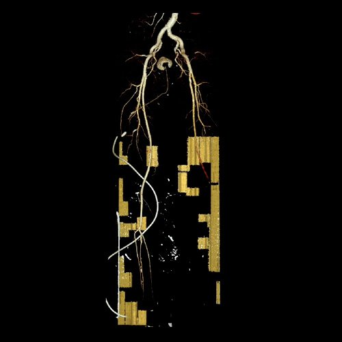 Angio TAC de miembros inferiores (Día 0)