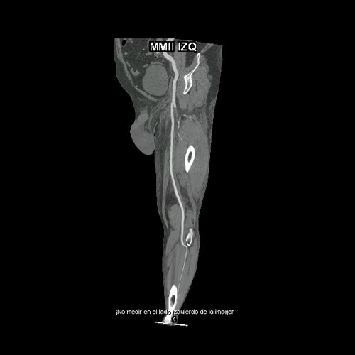 Angio TAC de miembros inferiores (Día 2)