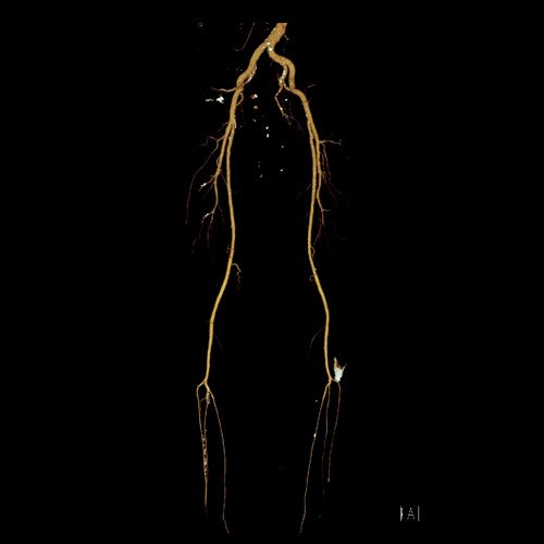 Angio TAC de miembros inferiores (Día 2)