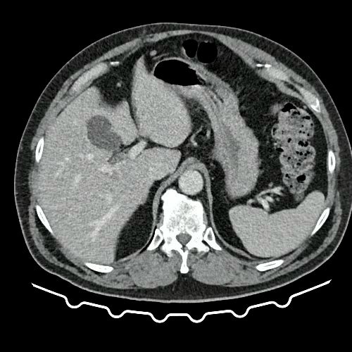 TAC de tórax, abdomen y pelvis con contraste EV (Día 10) Corte axial