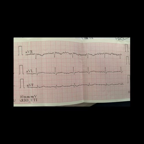 Electrocardiograma DÍA 0