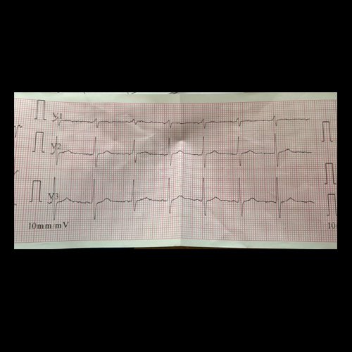 Electrocardiograma DÍA 0