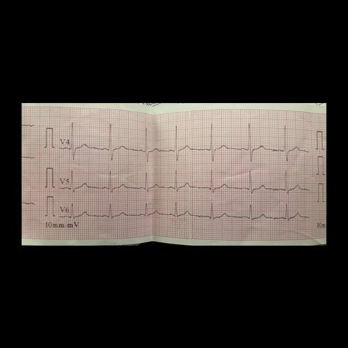 Electrocardiograma DÍA 0