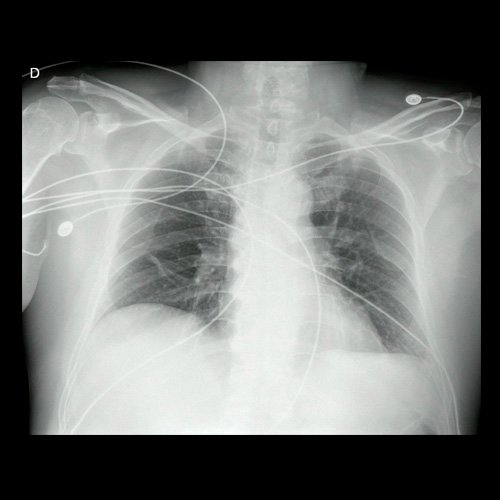 Radiografía de tórax al ingreso (Día 0)