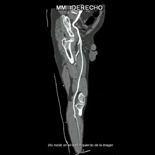 Angio TAC de miembros inferiores (Día 0)