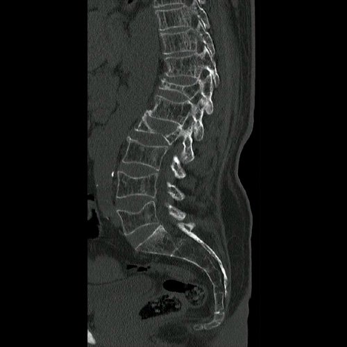 TAC  de columna lumbosacra (Día 0):  Corte sagital 
