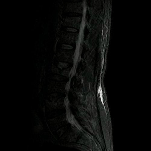 Fracturas patológicas: los sospechosos de siempre