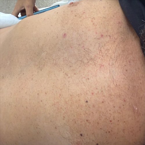 Ginecomastia y telangiectasias