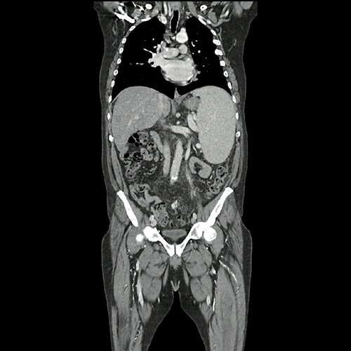 Tomografía de abdomen y pelvis con contraste. Corte coronal. VER CUAL