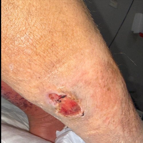 Úlceras crónicas en miembro inferior derecho.