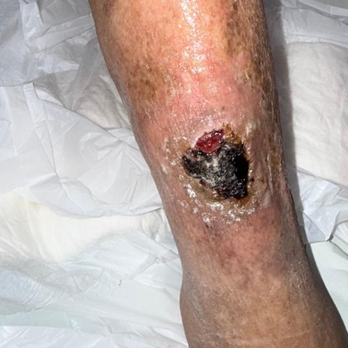 Úlceras crónicas en miembro inferior derecho.
