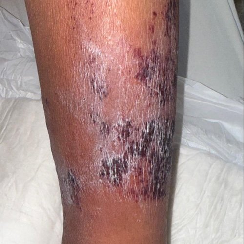  Lesiones en miembro inferior izquierdo.