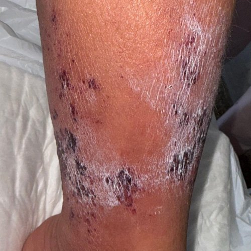  Lesiones en miembro inferior izquierdo.