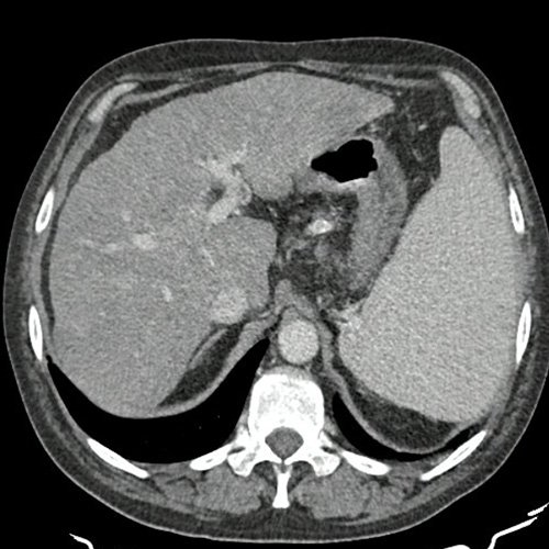 De la malabsorción al compromiso cutáneo: lesiones en miembros inferiores en paciente cirrotico con celiaquía no tratada