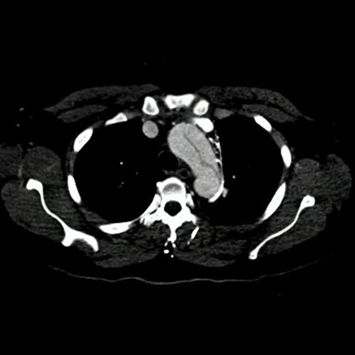 Angiotomografía con contraste endovenoso de cayado aórtico. Corte axial. 