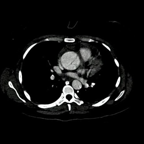 Disección aórtica en mujer joven: desafío etiológicos en contexto autoinmune