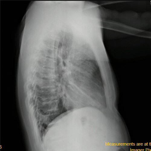 Radiografía de tórax frente y perfil. (día 3). 