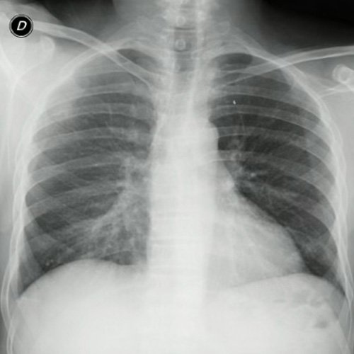 Radiografía de tórax frente y perfil. (día 3). 