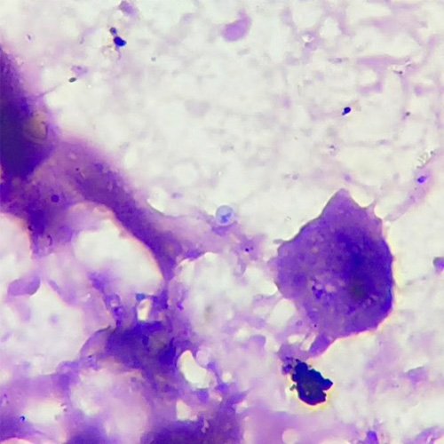 Examen directo con tinción Giemsa de biopsia cutánea. 