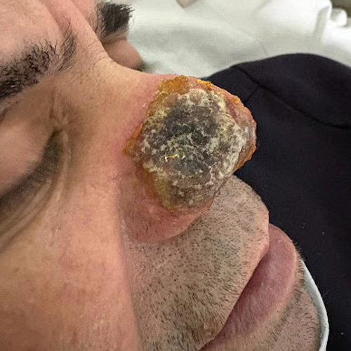 Lesiones en un huésped vulnerable: cuando la piel habla