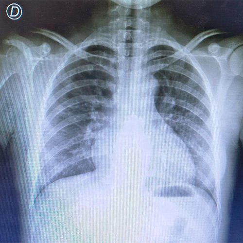 Cuando el tratamiento confunde: lesiones dérmicas tras el manejo de nefritis lúpica