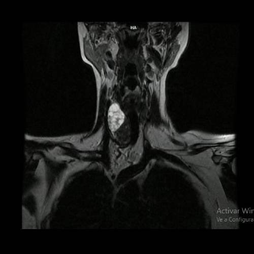 Mujer de 31 años con fractura en C2 y tumoración laterocervical derecha.