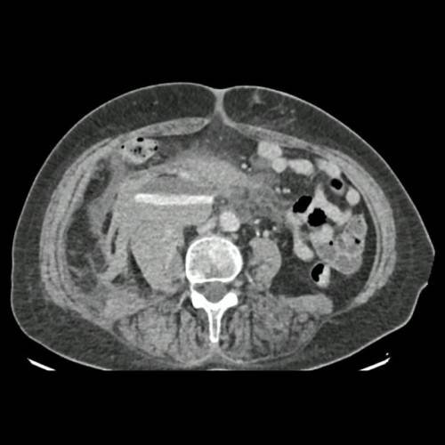 Cuando los problemas se encadenan: mujer de 68 años con endocarditis infecciosa, complicaciones trombo-hemorrágicas e insuficiencia cardíaca